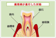 歯周病治療